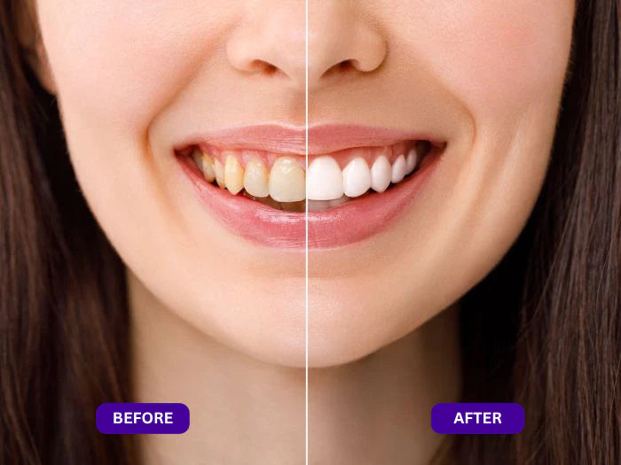 Amzoo Purple Teeth Whitening Strips