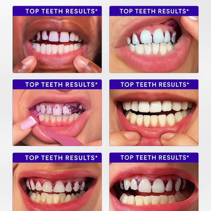 Amzoo Purple Teeth Whitening Strips